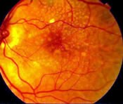 Macular SM