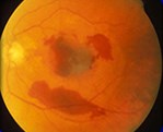 Wet Macular Degeneration