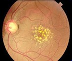 Dry Macular Degeneration